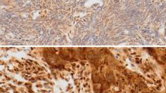 numérisation d’un marquage ADAR1 sur deux échantillons de cancer du sein triple-négatif 